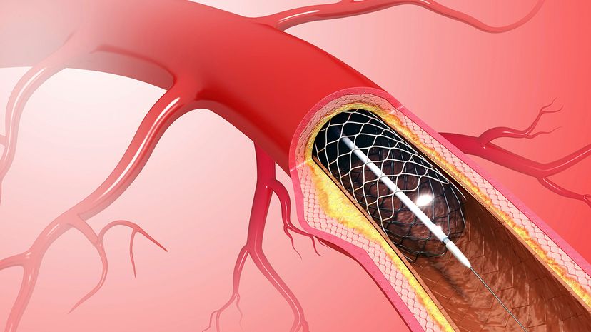 heart stent angioplasty