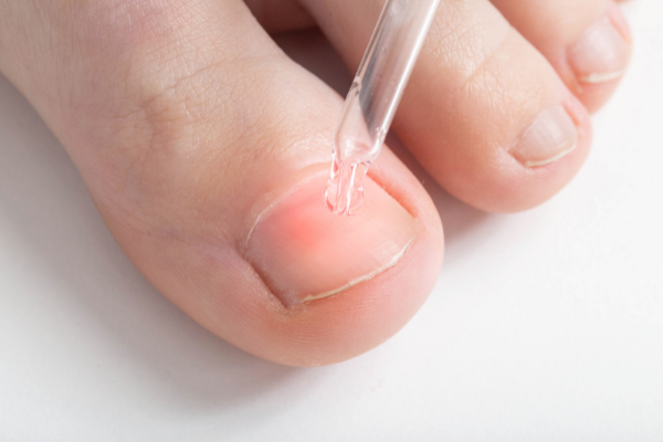 7 Home Remedies for Nail Fungus That Work | Nail fungus is common but unpleasant. It can appear on your fingernails and toenails, causing discolouration, cracks, and brittle nails. Thankfully, it can be cured, and we're curated the best homemade natural remedies to get rid of toenail fungus fast. Click to find out how you can get rid of a toenail fungal infection ASAP using ingredients you probably already have on hand, like apple cider vinegar, essential oils, black tea, and more!